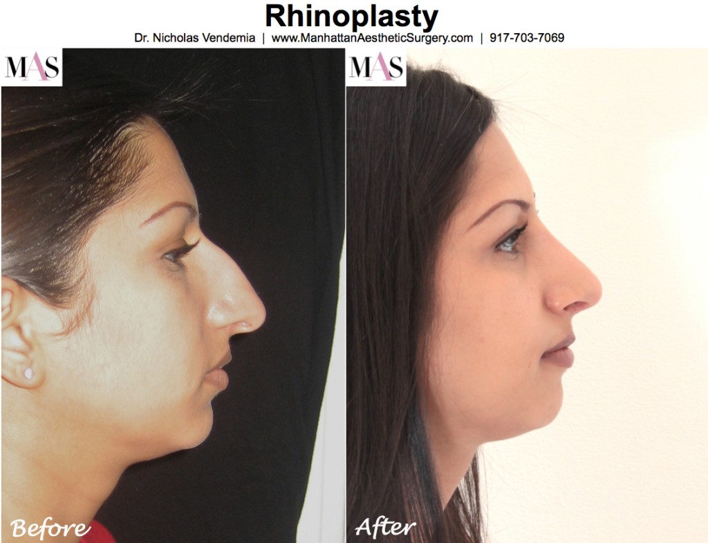 Rhinoplasty-5d-1024x785.jpg