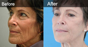 Belotero Filler New York City Dr. Nicholas Vendemia Belotero Filler New York City Dr. Nicholas Vendemia