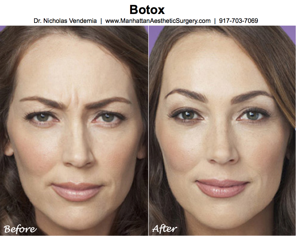 Botox® Cosmetic Wrinkle Reduction New York City