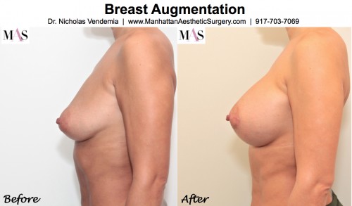 breast enlargement new york, breast augmentation nyc, plastic surgeons nyc