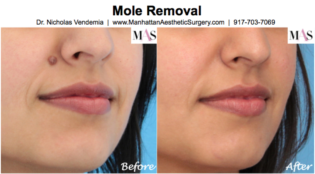 Facial Mole Removal Surgery 51