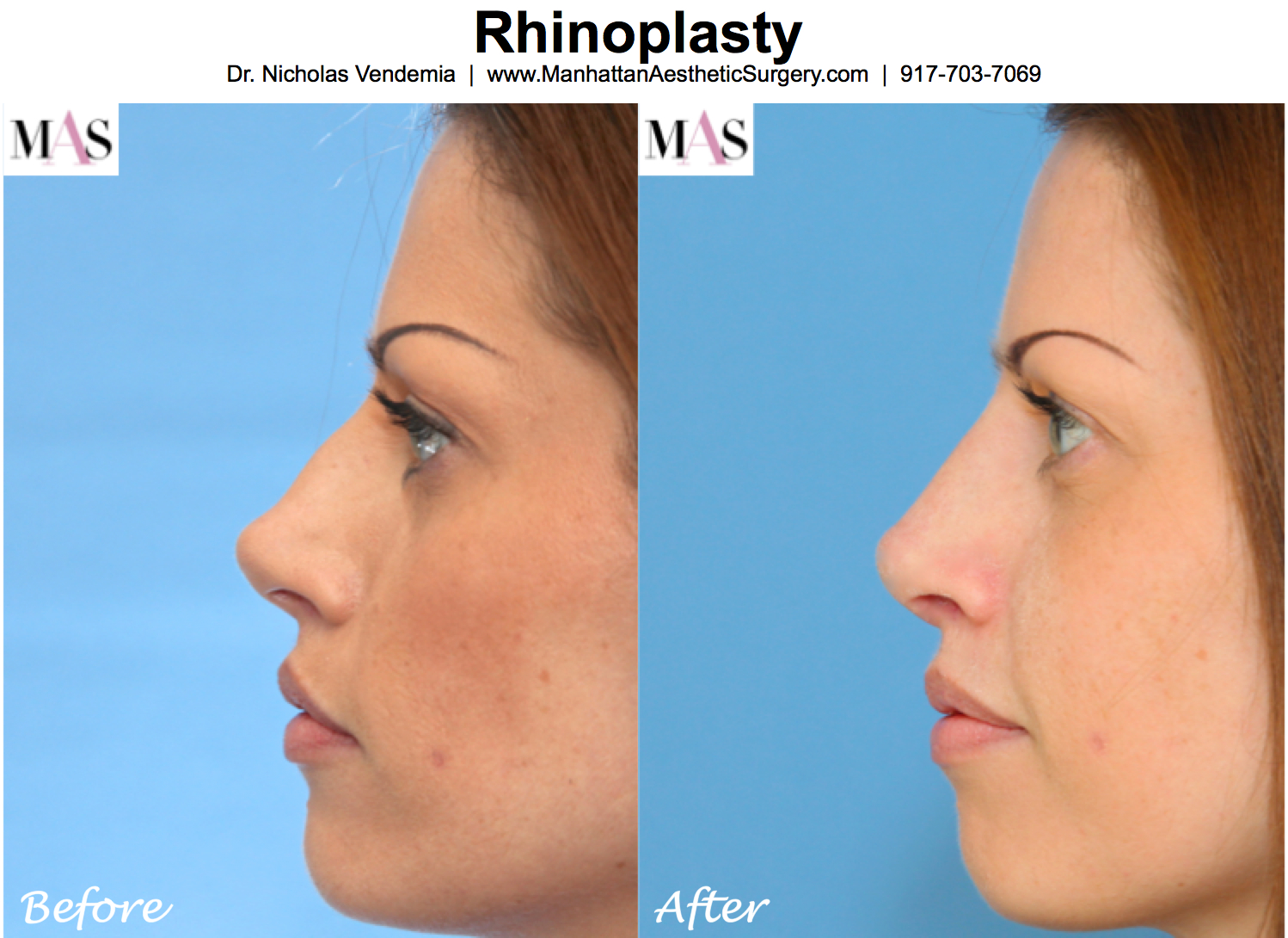 Nose surgery in New York by Rhinoplasty expert Dr. Nicholas Vendemia of MAS