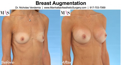 breast augmentation in new york, breast augmentation nyc, breast implants nyc, breast augmentation at MAS, breast augmentation with dr nicholas vendemia
