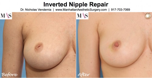 inverted nipple repair in new york city