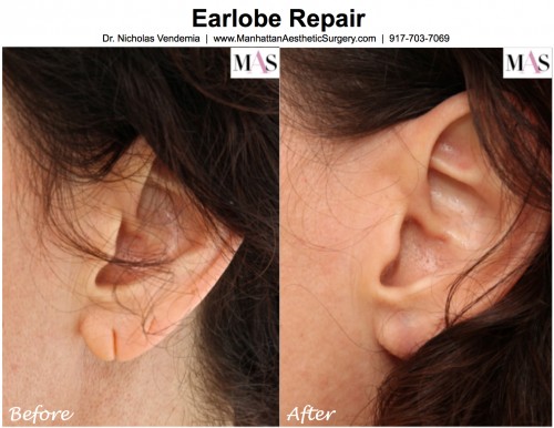 earlobe repair procedure. fix a torn earlobe