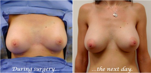 breast implants during surgery and one day after