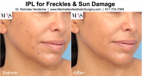 IPL treatments for summer sun damage and freckles