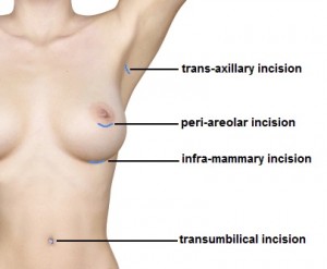 incision choices for breast augmentation surgery