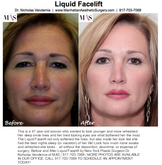 laser liquid facelift