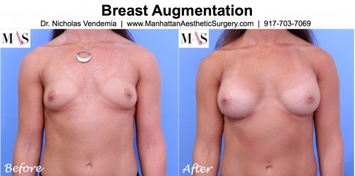 before and after breast augmentation front view