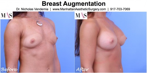 before and after breast augmentation oblique view