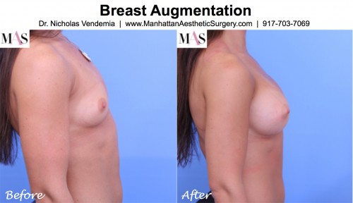 breast augmentation before and after side view
