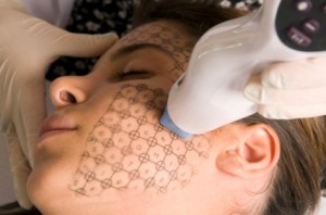 acne scar treatment options in new york