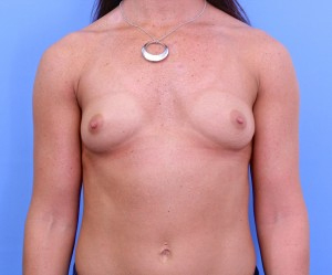 breast augmentation nyc before and after photos manhattan | New York City 