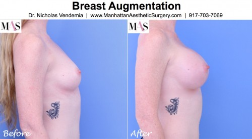breast augmentation photos before and after