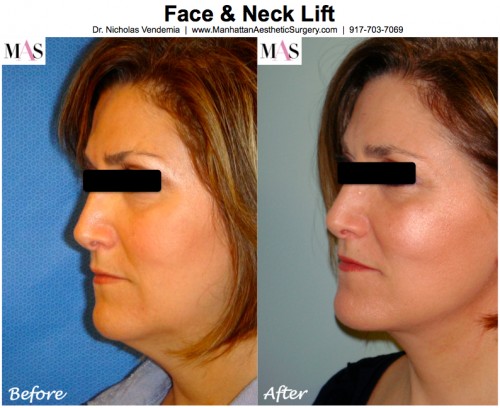 best facelift surgeons in new york