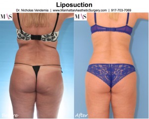 liposuction for bra rolls in new york