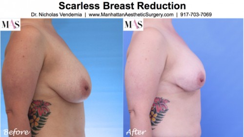 photos of the scarless breast reduction
