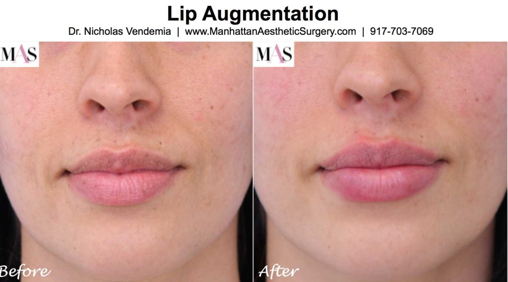 Lips augmentation for smoother lips