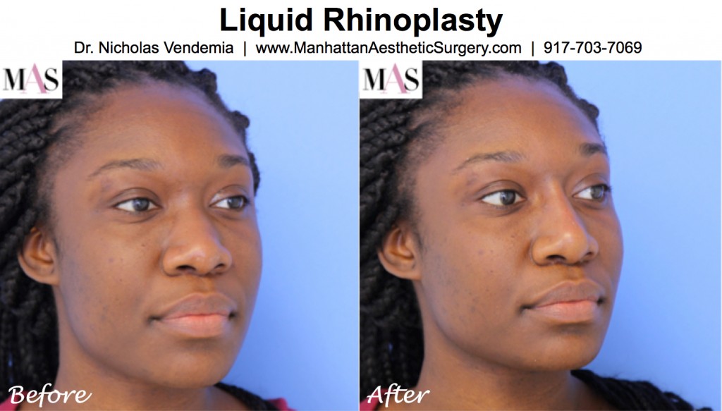 liquid rhinoplasty before and after