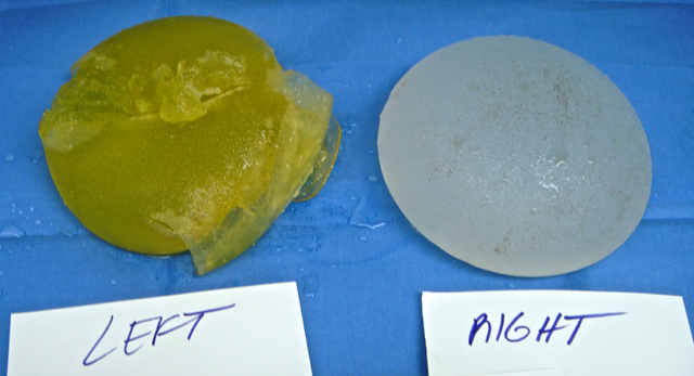 PIP breast implant removal