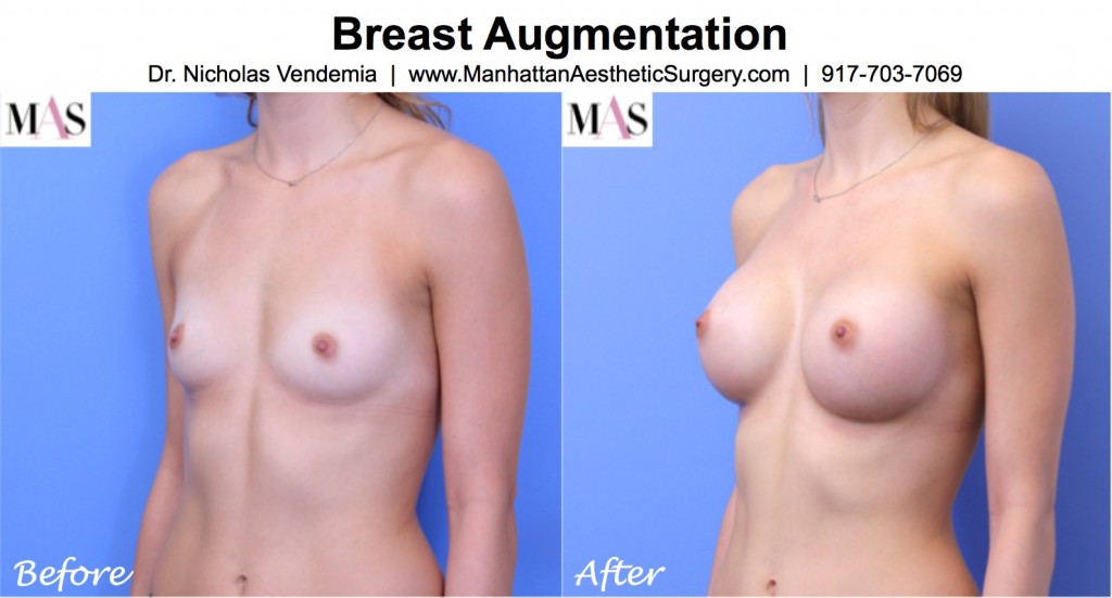 rapid recovery breast augmentation new york