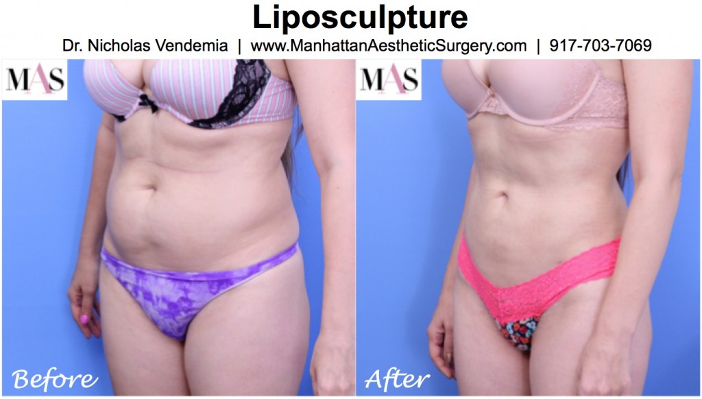 Before and After liposculpting result by Dr. Nicholas Vendemia of MAS
