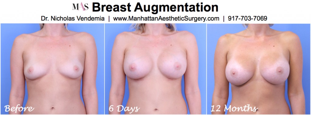 How breast implants settle over time after breast augmentation surgery