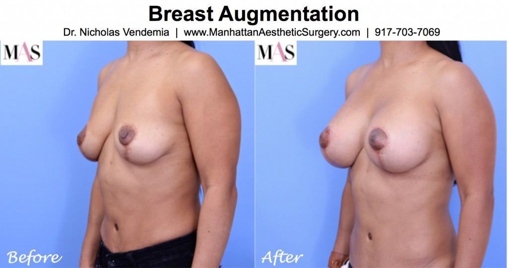 breast augmentation after mastopexy