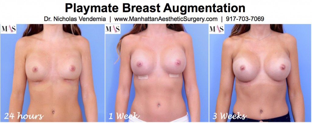 Playmate breast augmentation before and after photo