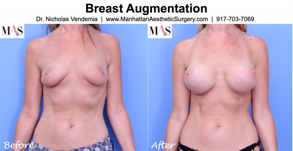 before and after photo 2 months after breast augmentation