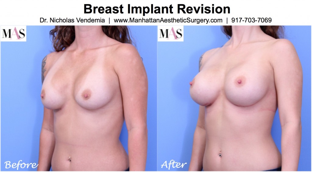 Before and After breast implant exchange surgery