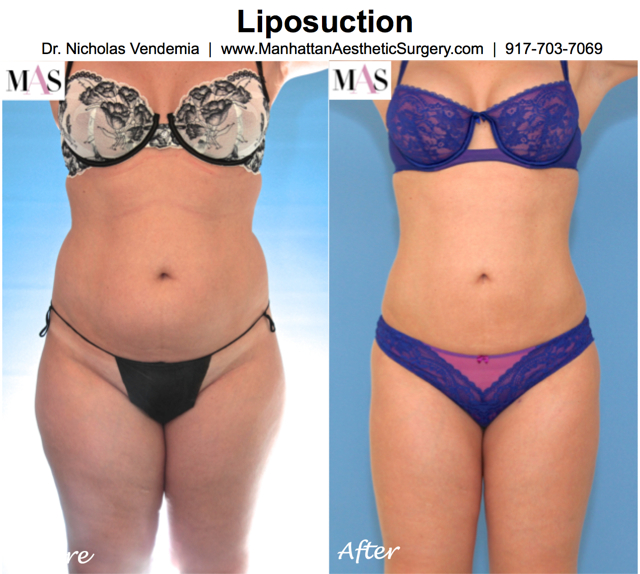 Lipo For Women Before & After NYC