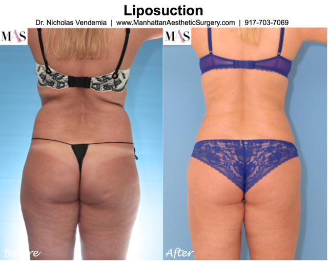 Liposuction Procedures, Manhattan Aesthetic Surgery