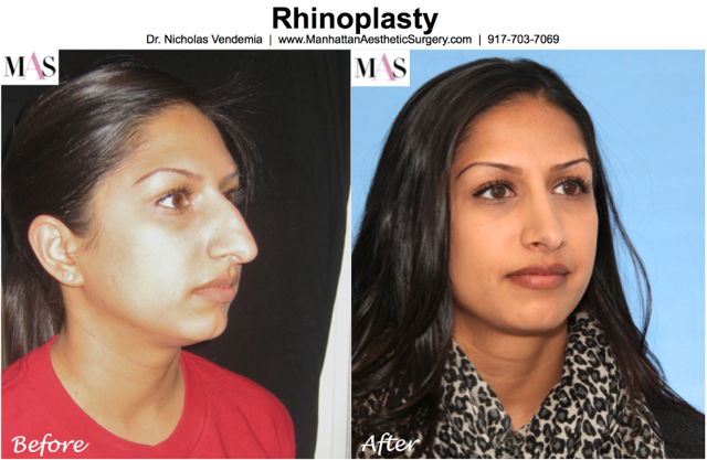 Rhinoplasty Manhattan Aesthetic Surgery Dr. Nicholas