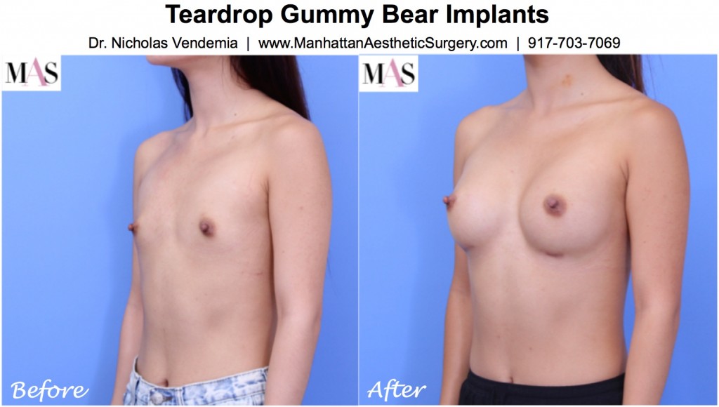 290cc Teardrop Gummy Bear Implant: 3/4 View